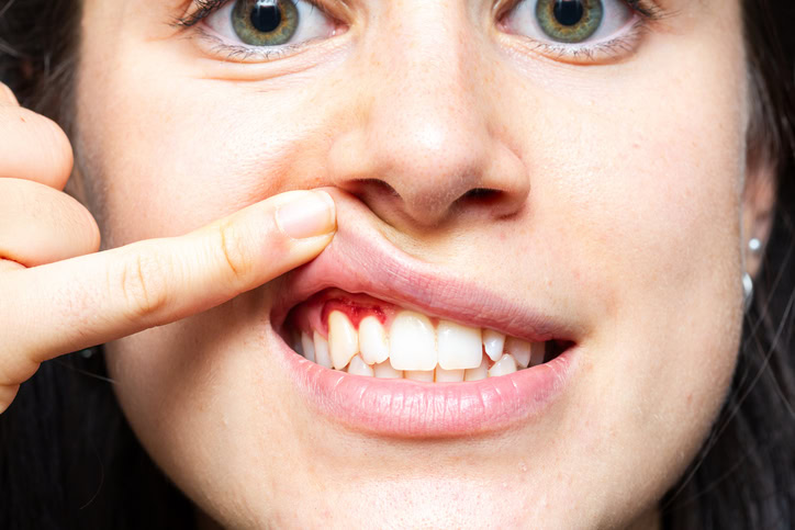 Closeup of a girl with bleeding gums lifting her lip with her finger. Macro of a woman's mouth with red gums. Inflammation caused by gingivitis