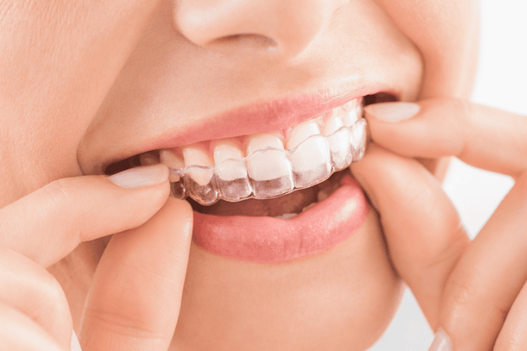 Dentist Gold Coast Clear Aligners