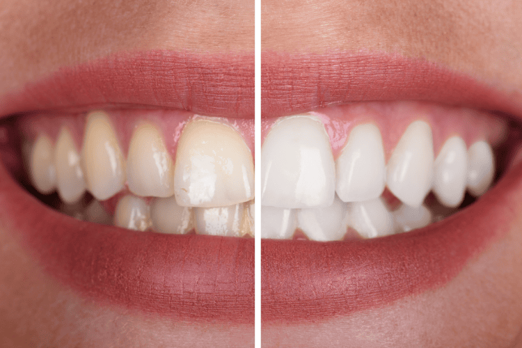 Dentist Gold Coast Teeth Whitening